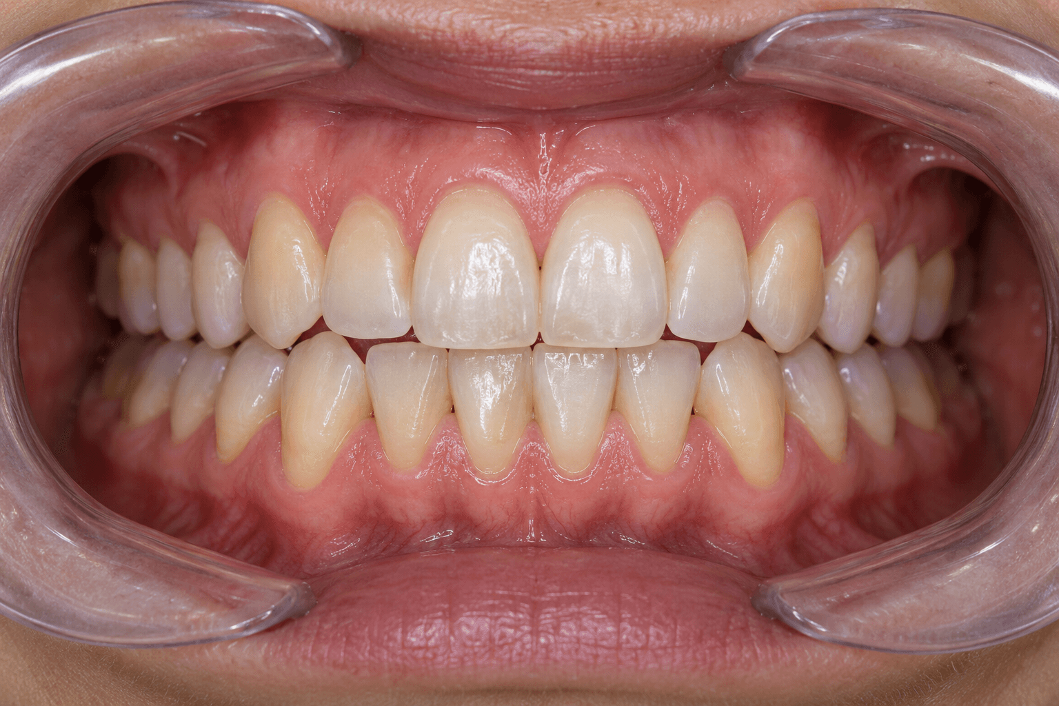 Fotografía intraoral frontal antes del tratamiento