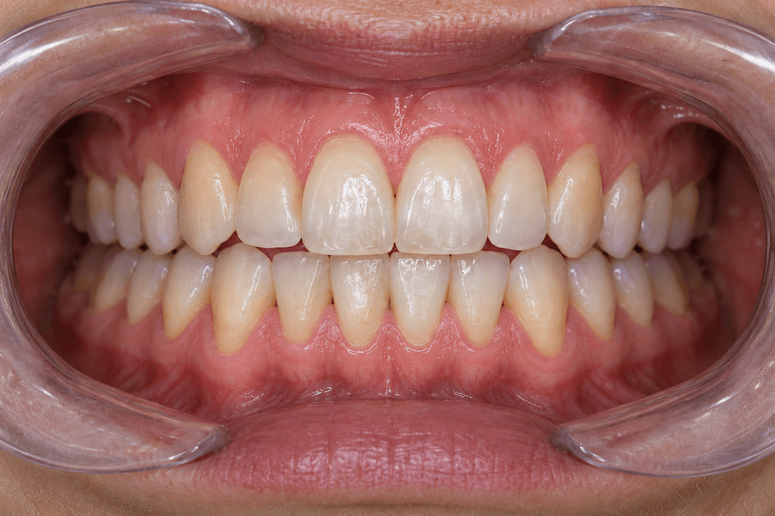 Fotografía intraoral frontal al terminar el tratamiento